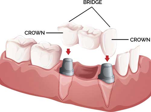 denture care instructions hobart